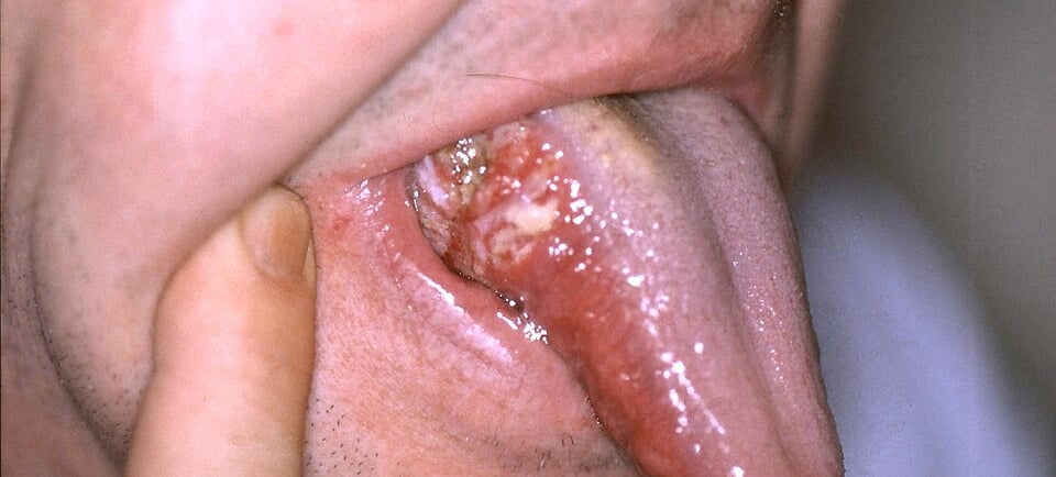 Early symptom of oral cancer in Indian women - mouth sore on tongue"