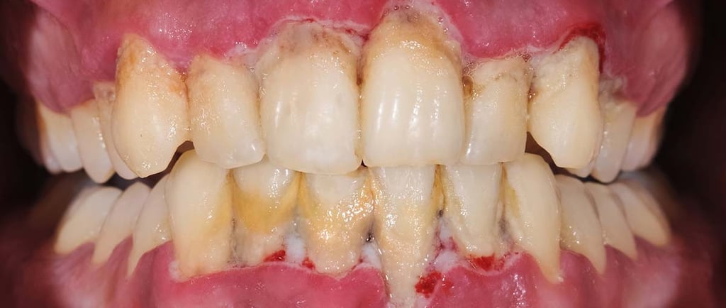 calculus formed on teeth with swollen gums
