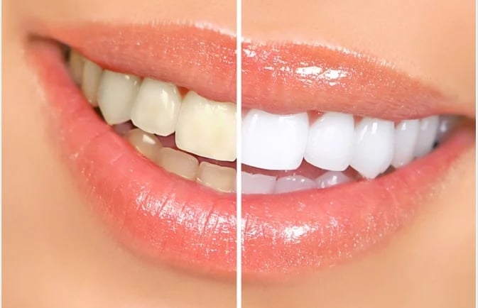 an image showing stained and whitened teeth 