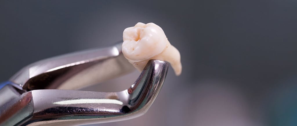 a image showing extracted molar teeth in forceps