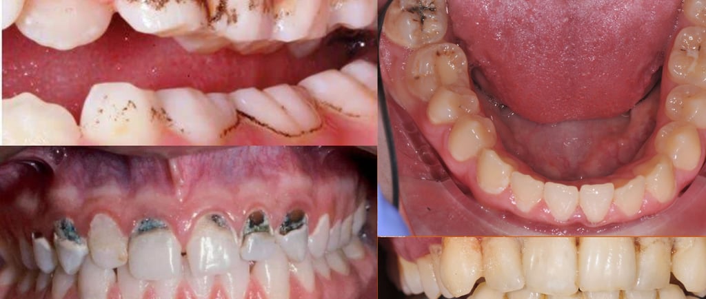 black spots on teeth 