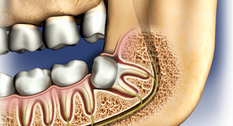 a image showing impacted third molar