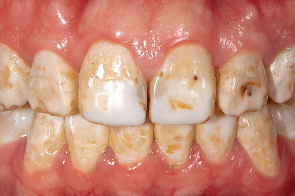 a image showing yellow brown stains on teeth