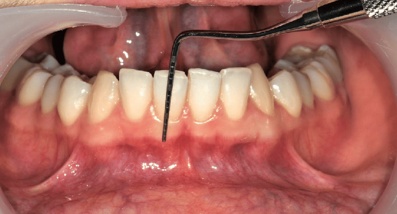 an image showing williams probe in the background of open mouth