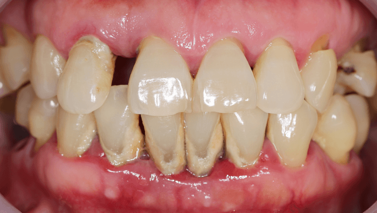 an image showing teeth with plaque and calculus