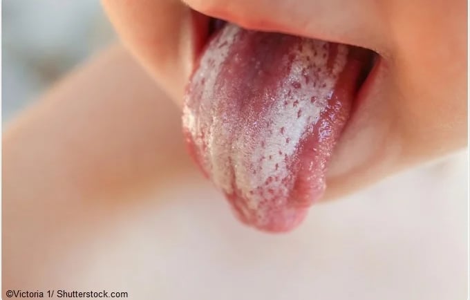 an image showing white lesions in baby tongue