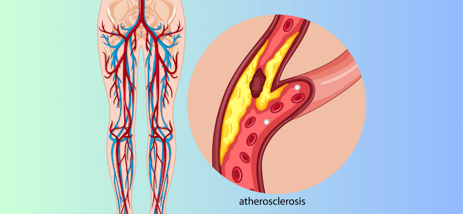 Medical diagram showing Peripheral Artery Disease (PAD) with narrowed leg arteries and reduced blood flow, illustrating sympt