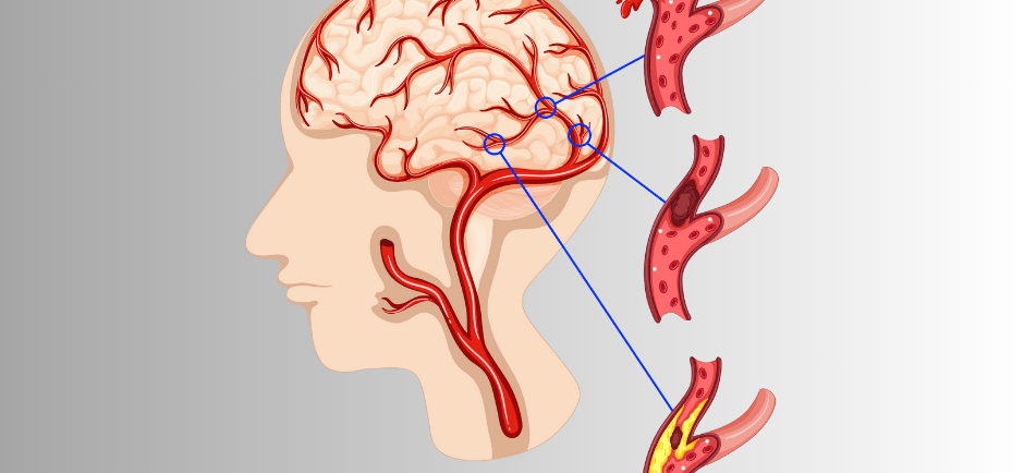 Medical illustration of an aneurysm showing a weakened, bulging section of a blood vessel wall, highlighting risks and sympto