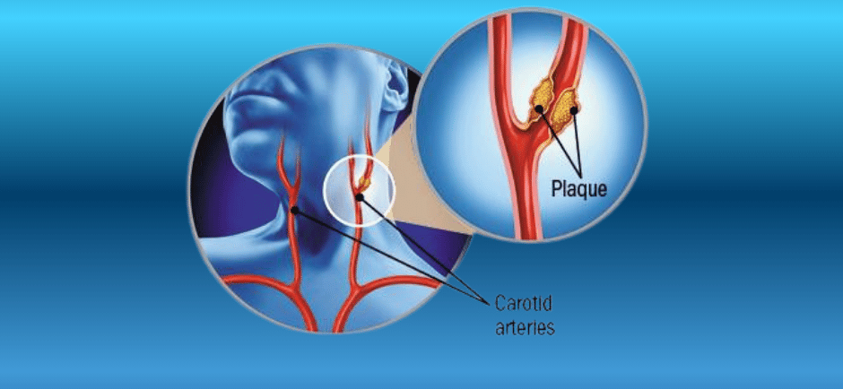 Medical illustration of Carotid Artery Disease showing plaque buildup in the carotid arteries of the neck, leading to reduced