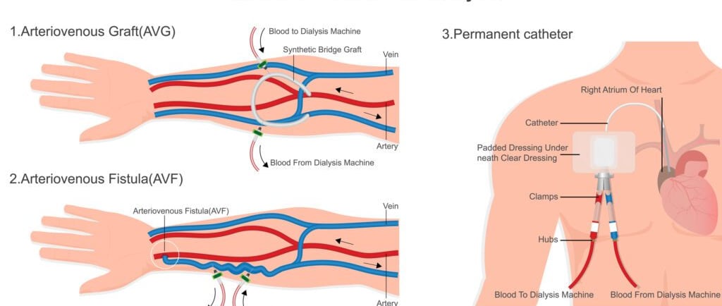 Illustration showing dialysis access types: arteriovenous fistula and graft used for hemodialysis treatment.