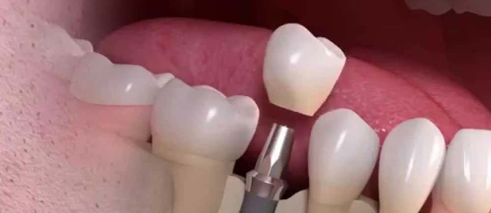 Beautify Your Smile With Dental Implants in Pune