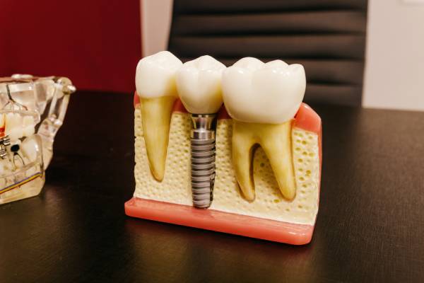 Dental Implants Treatment in Pune
