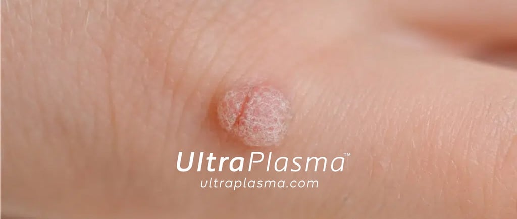 ultraplasma.com_wart_treatment_sigil_tedavisi_ultra_plasma_ultra_plazma_mouth_agiz