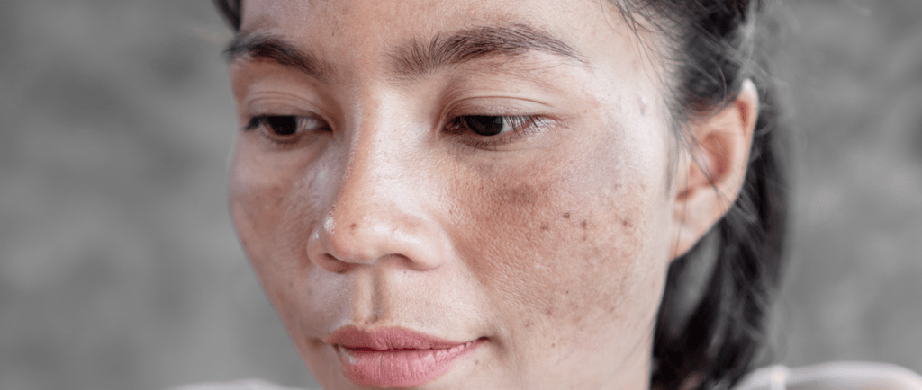 Mélasma du visage, masque de grossesse, personne asiatique avec mélasma
