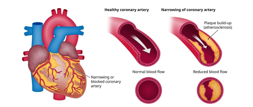 Coronary Artery Disease