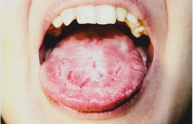Candidiasis