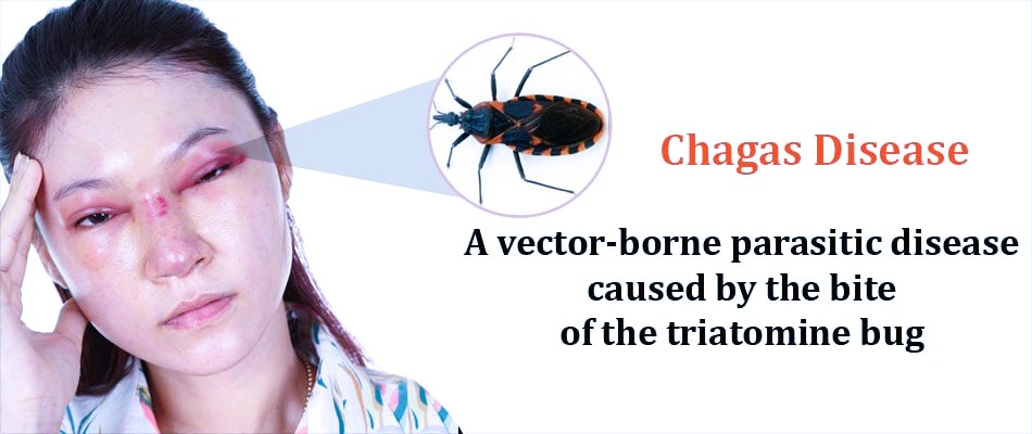 Chagas Disease