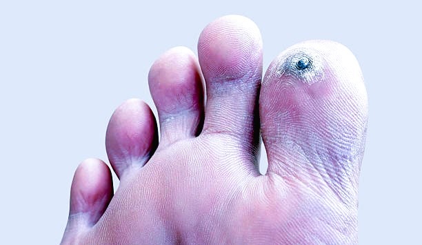 hyperkeratosis