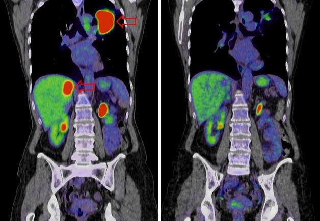 Liver Cancer