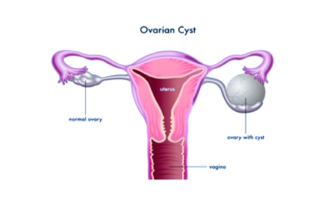 ovarian cysts