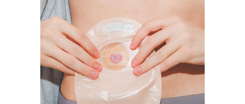 A person applying a transparent ostomy bag to their abdomen, showing a pink stoma through the adhesi