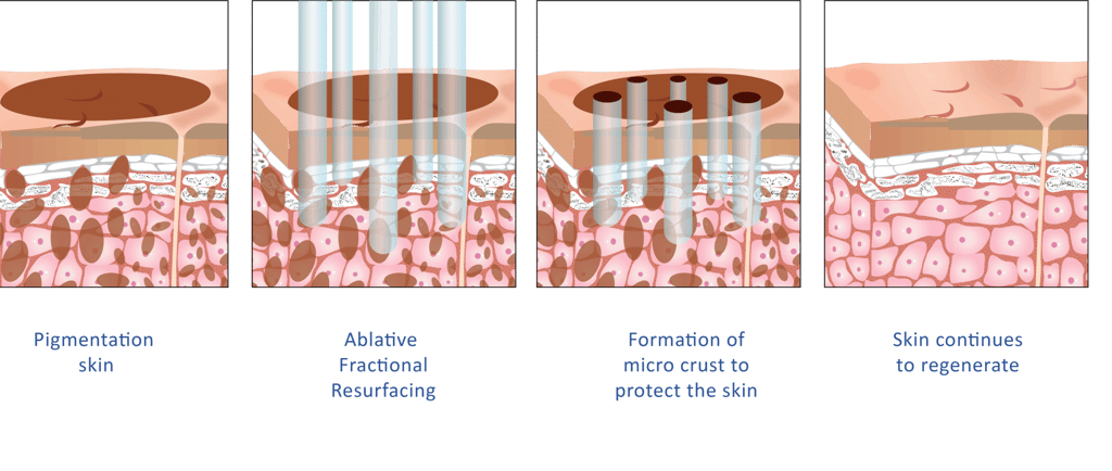 ablative fractional resurfacing laser diagram