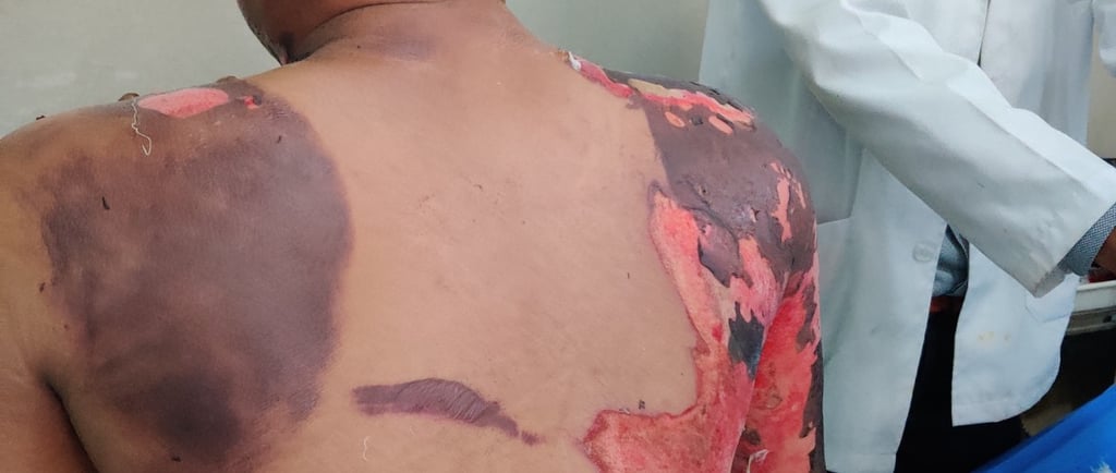 “Expert burn care in Udaipur provided by plastic surgeon Dr Bharat Agarwal”