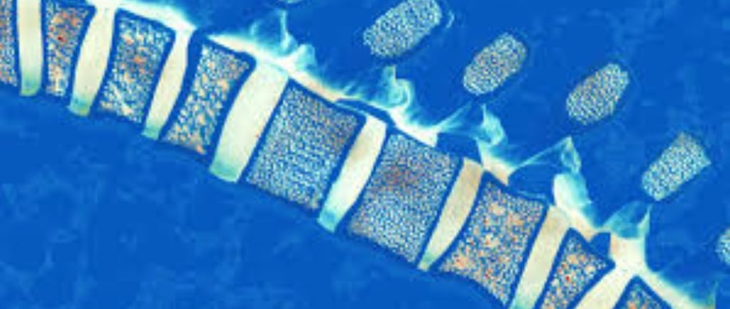bone collapse in multiple myloma