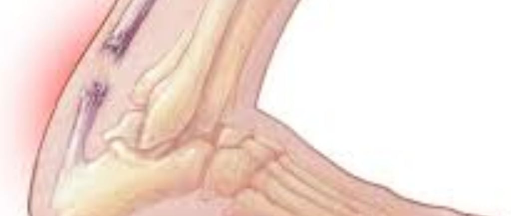Achilles Tendon Injury : Broad Overviews