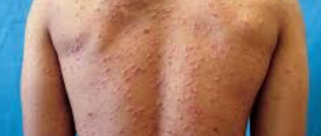 Fasting For Skin Allergies Itching & Pruritus