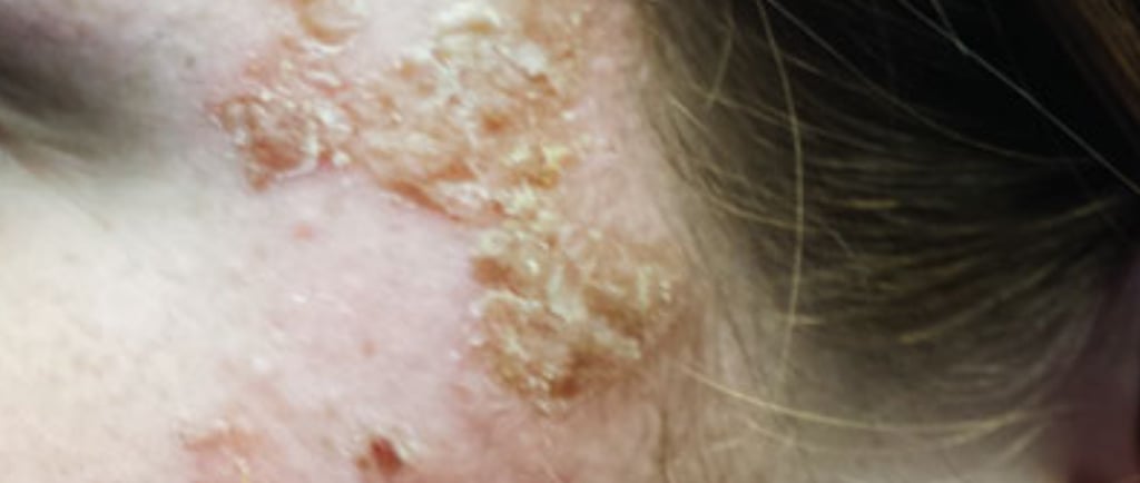 Herpes Simplex, Genitalia & Ophthalmicus herpes is a viral infection that can cause sores on the ge