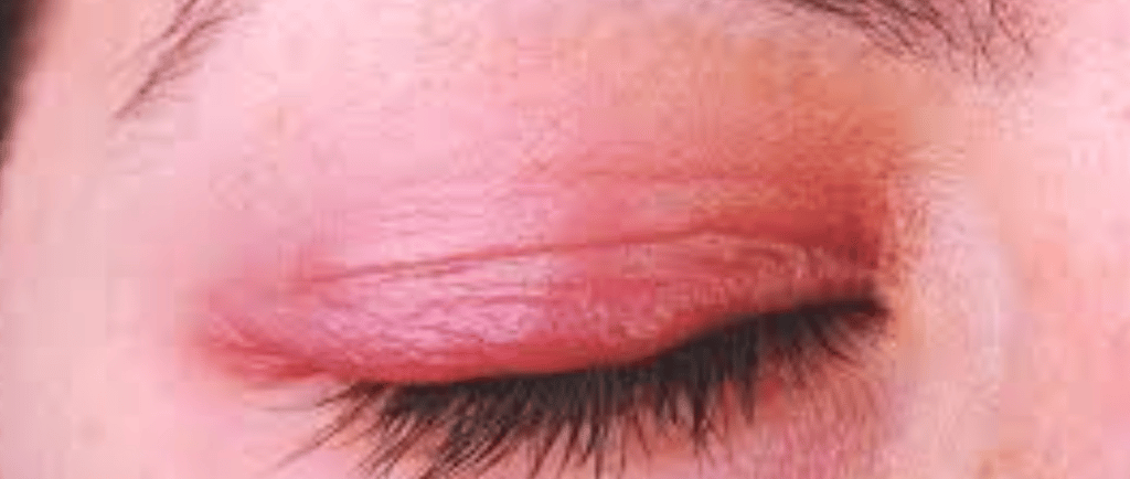 Watery eyes, dryness, itching, and burning in the eyes during fall and winter  Watery eyes, dryness,