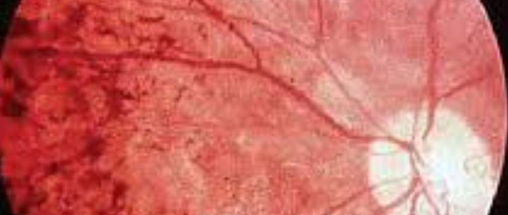retinitis pigmentosa