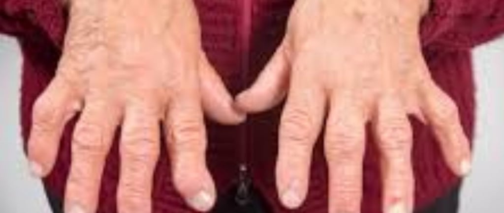 Rheumatoid Arthritis