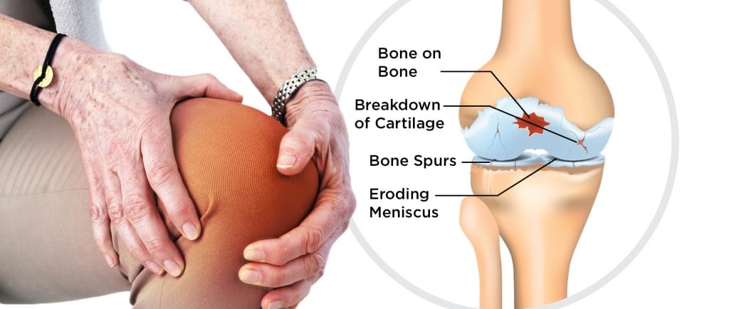 a person with a kneel pain