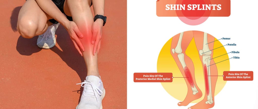 shin splints