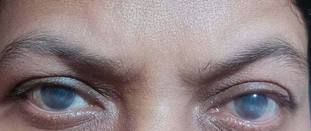 severe-dry-eyes-scleral-lens