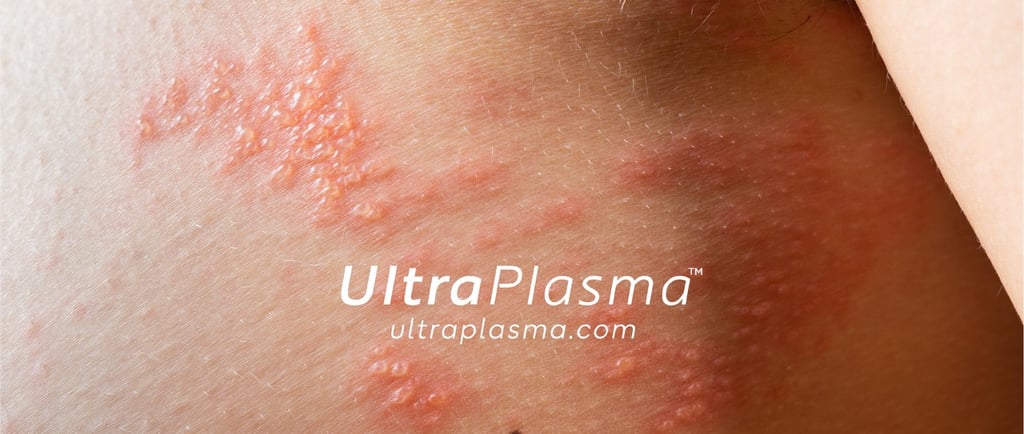 ultraplasma.com_chicken-pox-rash_treatment_su_cicegi_tedavi_ultra_plasma_ultra_plazma