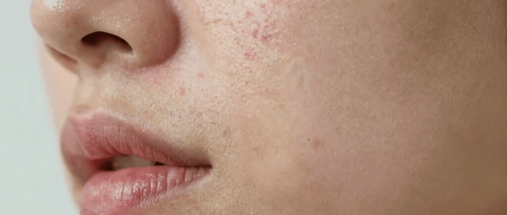 How to Get Rid of Acne & Pimples Without Causing a Breakout
