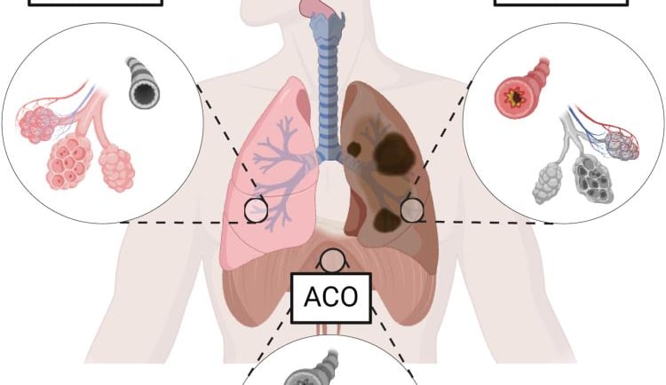 Asthma cure in Bhubaneswar