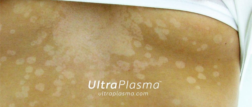 ultraplasma.com_Tinea_Versicolor_treatment_tinea_mantar_tedavi_ultrap_plasma_ultra_plazma