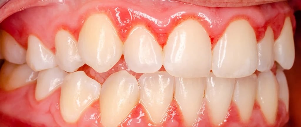 Gingivitis, periodontitis, sangrado encías