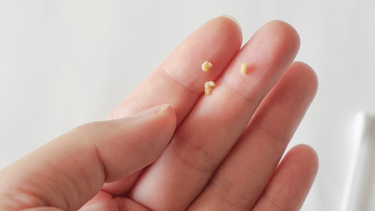 Tonsilolitos, cálculos amígdalianos, caseum y mal aliento