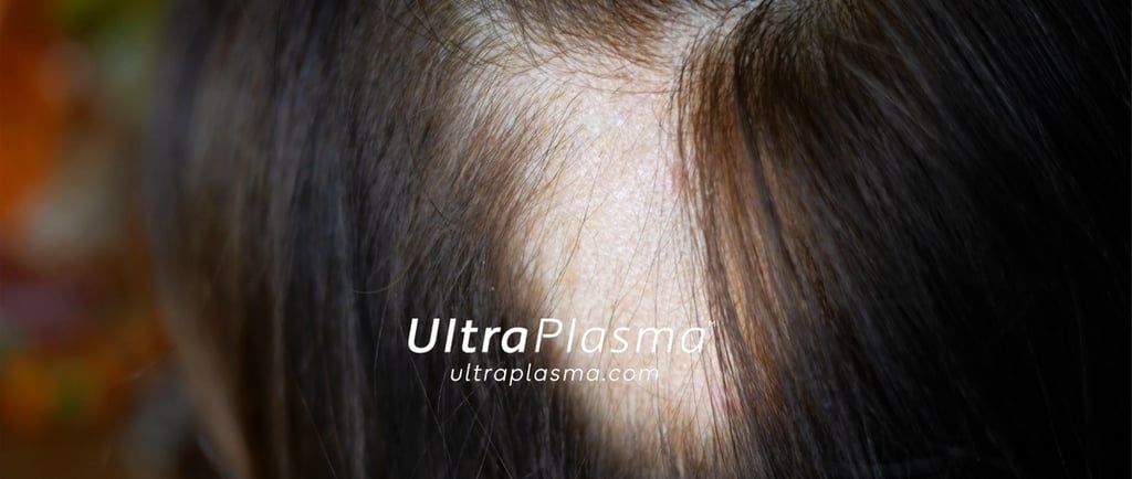 ultraplasma.com_alopecia_treatment_alopesi_tedavisi_ultra_plasma_ultra_plazma