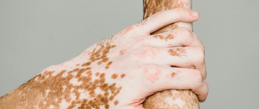 vitiligo treatment in pakistan