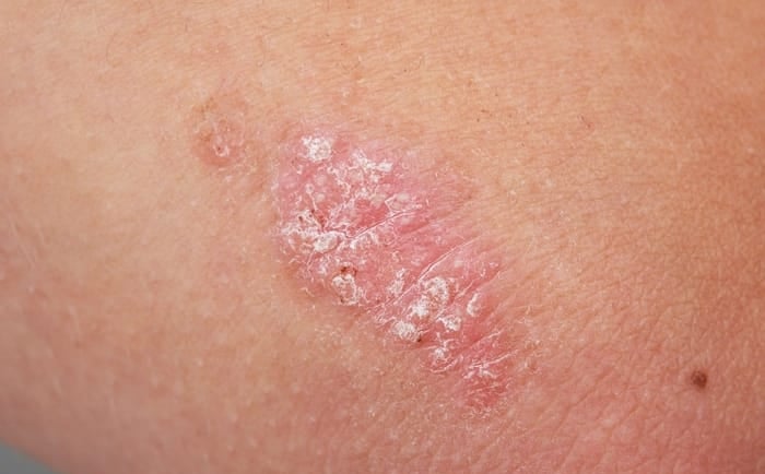 psoriasis meaning in urdu
