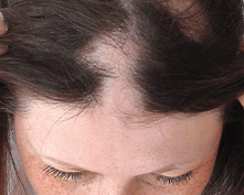 alopecia areata treatment in urdu