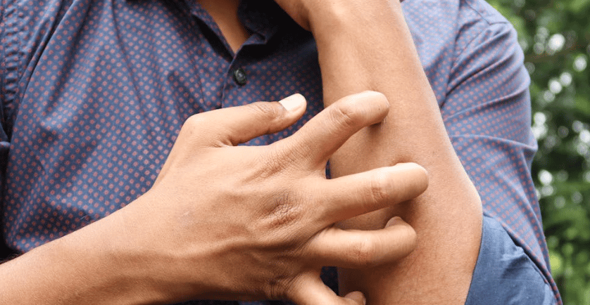 scabies skin disease