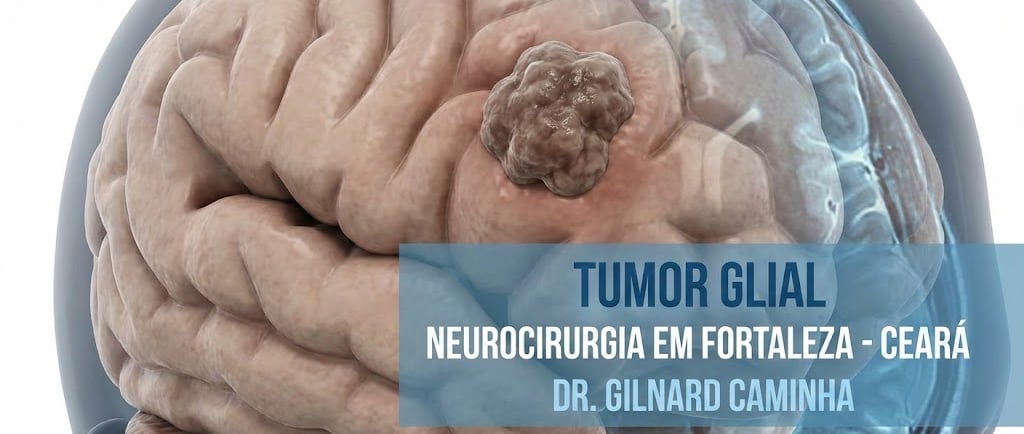 Medical illustration of a glial tumor on a human brain for neurosurgery in Fortaleza, Ceará.