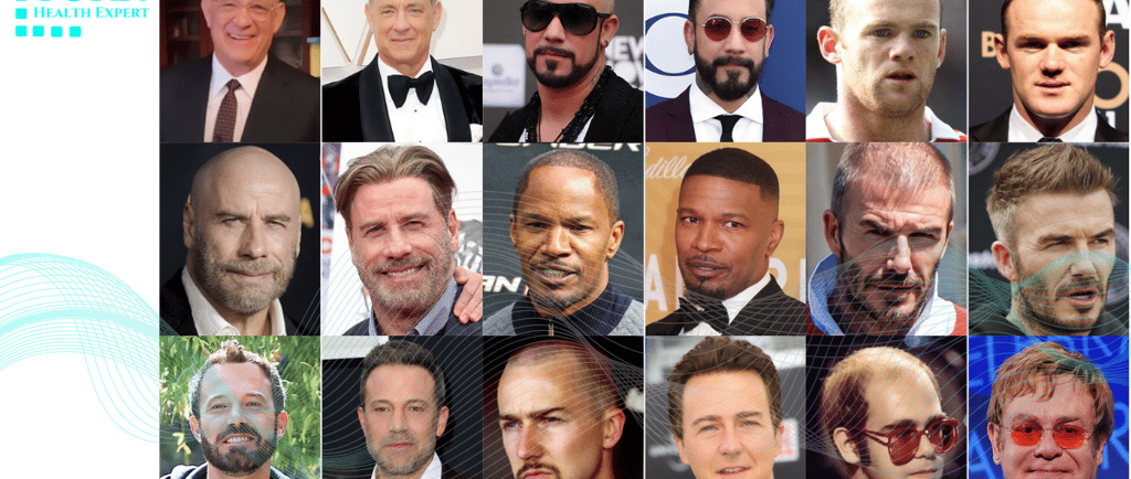 Celebrities hair transplants before and after